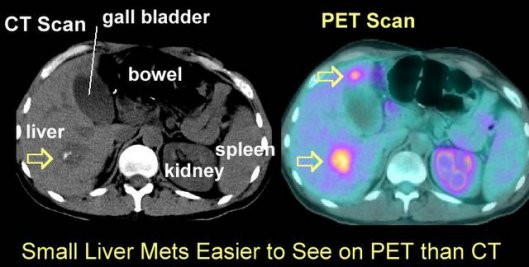 ct vs pet